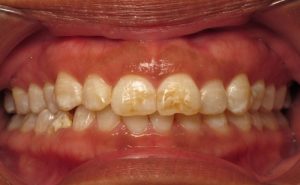 لکه های روی دندان